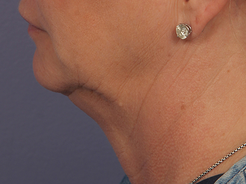 Kybella before and after photo