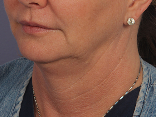 Kybella before and after photo