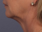 Kybella Before and after photo