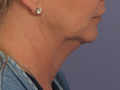 Kybella before and after photo